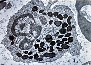 F,61y. | blood - eosinophilic granulocyte